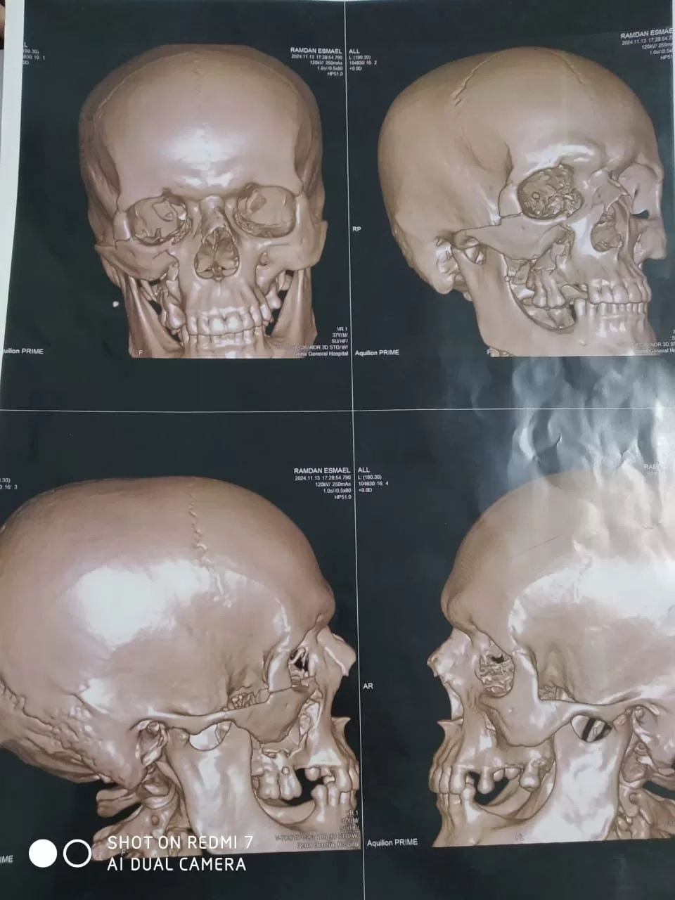 جراحة دقيقة بمستشفى قنا العام تنقذ وجه شاب من تشوه دائم 21 - جريدة المساء