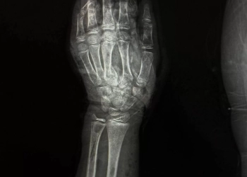 إنقاذ ذراع طفل بعد إصابة مروعة بطاحونة قمح بمستشفى سوهاج الجامعى 25 - جريدة المساء