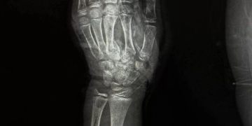 إنقاذ ذراع طفل بعد إصابة مروعة بطاحونة قمح بمستشفى سوهاج الجامعى 1 - جريدة المساء