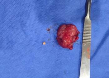 جراحة ناجحة لاستئصال غدة لطفل 11 عامًا بمستشفى قنا العام 25 - جريدة المساء جراحة ناجحة لاستئصال غدة لطفل 11 عامًا بمستشفى قنا العام 24 - جريدة المساء