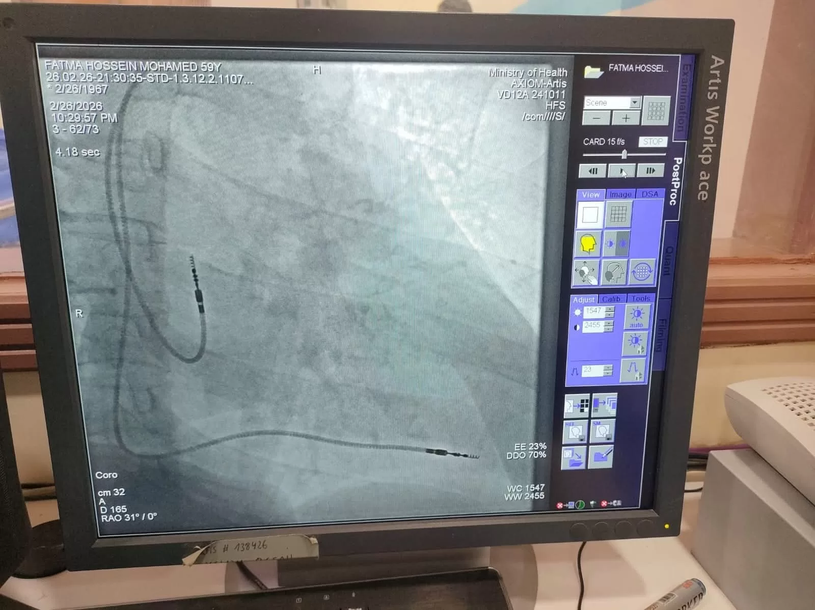 نجاح طبي جديد بمستشفى قفط التخصصي.. إنقاذ مريضتين بزراعة منظم ضربات القلب 25 - جريدة المساء