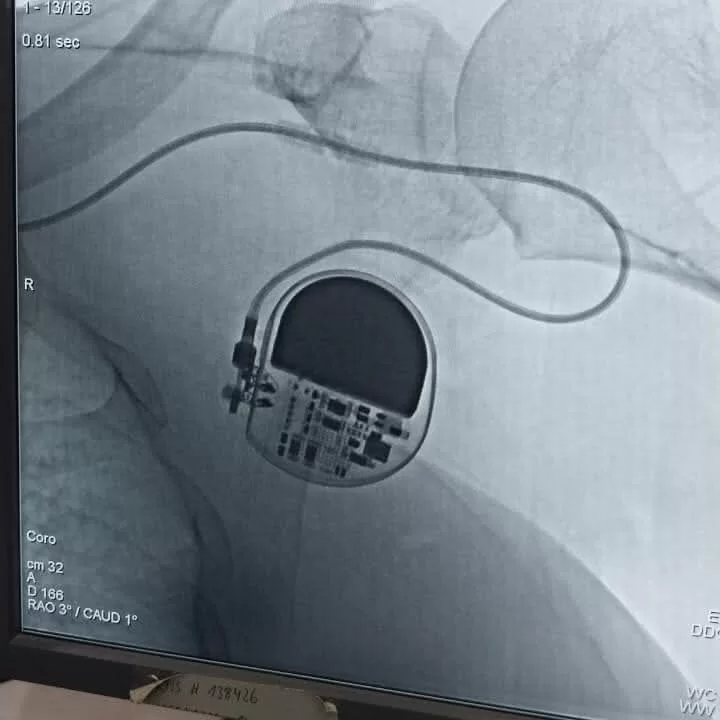نجاح طبي جديد بمستشفى قفط التخصصي.. إنقاذ مريضتين بزراعة منظم ضربات القلب 28 - جريدة المساء نجاح طبي جديد بمستشفى قفط التخصصي.. إنقاذ مريضتين بزراعة منظم ضربات القلب 27 - جريدة المساء