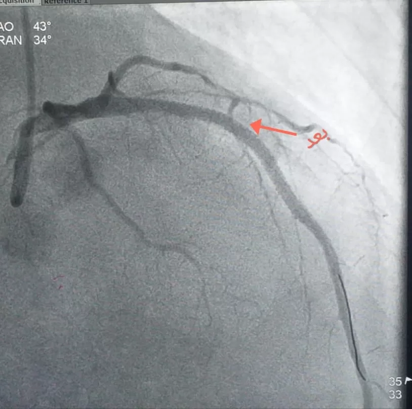 قسطرة قلبية عاجلة تنقذ شابًا داخل مستشفى قنا العام 23 - جريدة المساء
