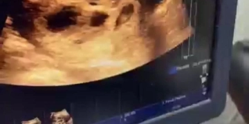 معجزة طبية فى قنا.. سيدة تحمل 8 توائم بعد 4 سنوات انتظار الإنجاب 1 - جريدة المساء