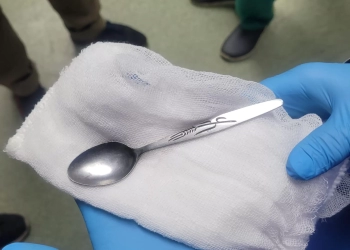 استخراج "ملعقة" من معدة مريضة بالمنظار .. بمستشفى كبد المنوفية 80 - جريدة المساء