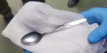 استخراج "ملعقة" من معدة مريضة بالمنظار .. بمستشفى كبد المنوفية 1 - جريدة المساء